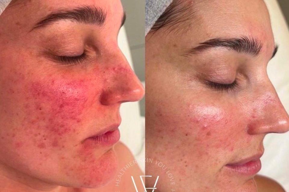 Signs of Damage Skin Barrier - redness, acne, roughness, acne