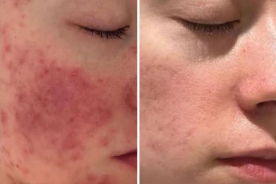 Damaged Skin Barrier - Before and After Treatment