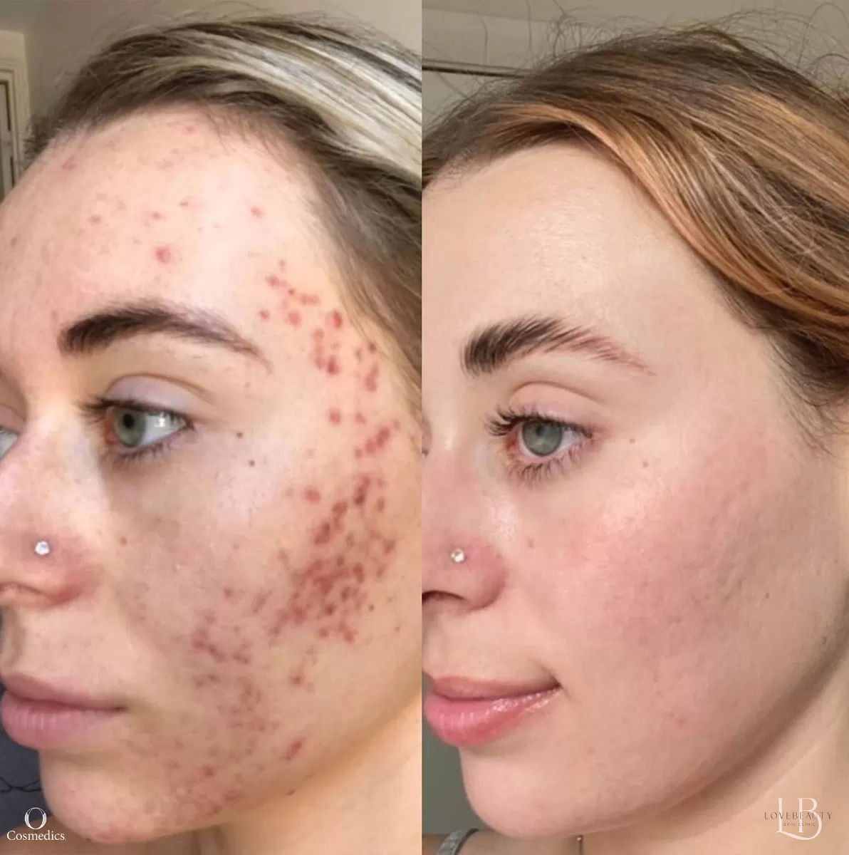 o_cosmedics_treatment_before_after_1 O Cosmedics Acne Treatment - Before and After