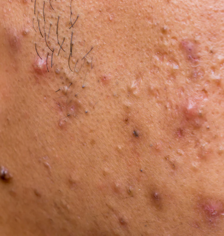 acne-prone-skin Skin Type- A lady with acne-prone skin