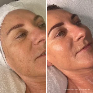 Before and After skin treatment
