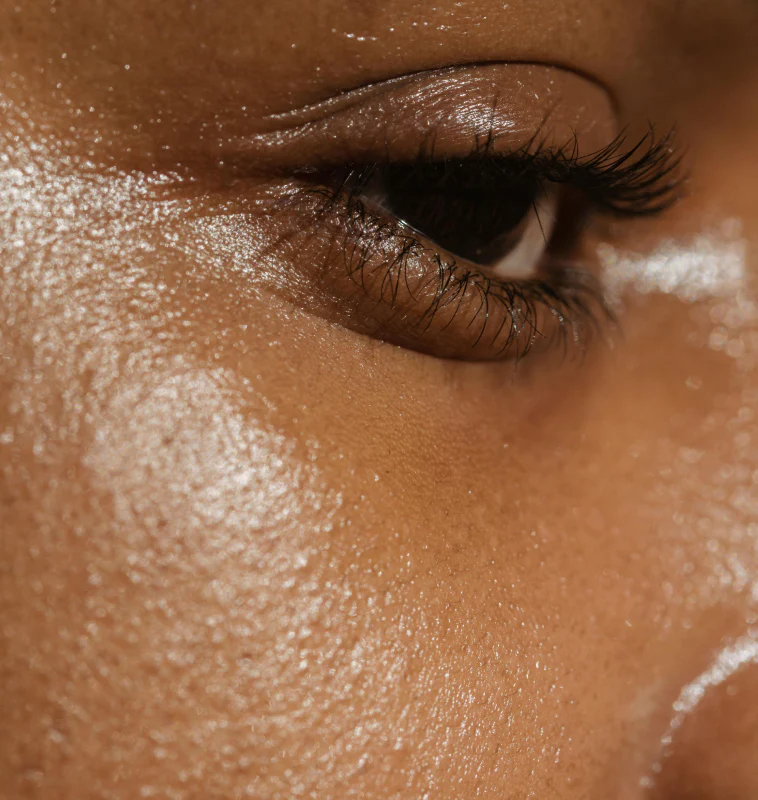 oily-skin Skin Type and Condition - Oily Skin ( A lady with oily skin)