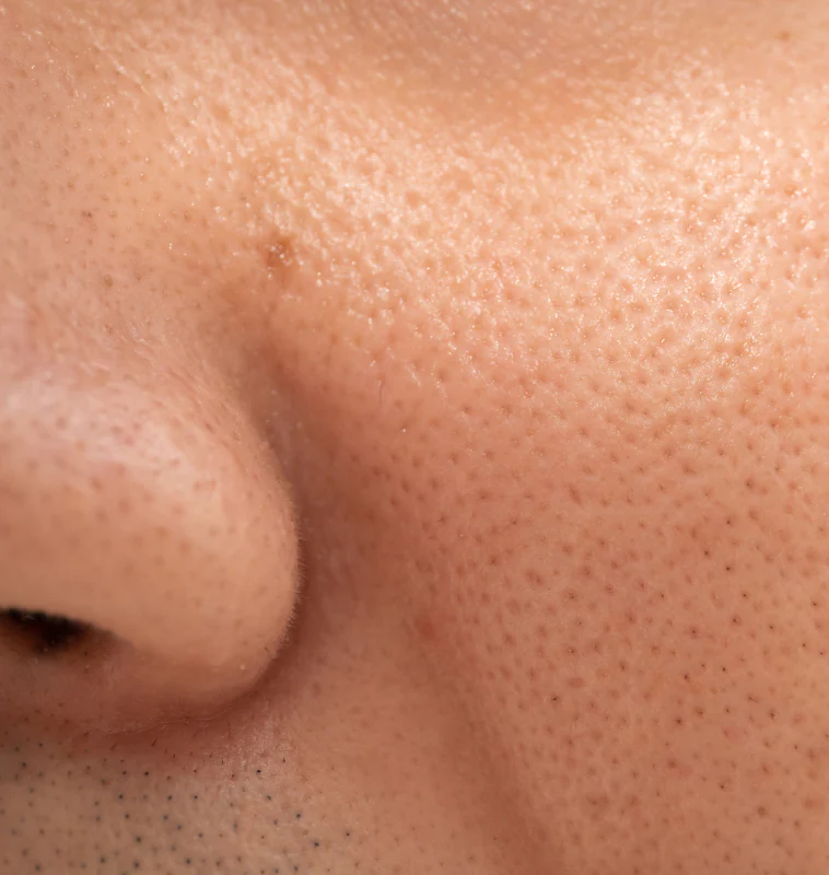 skin-pores True Skin - A lady with open pores
