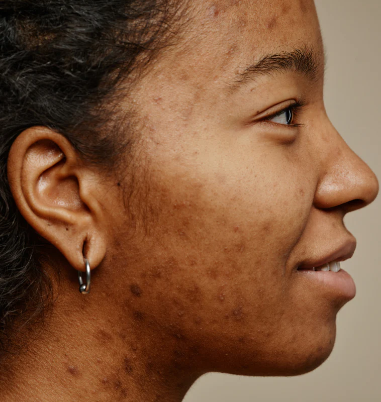 skin-with-hyperpigmentation A lady with hyperpigmentation condition