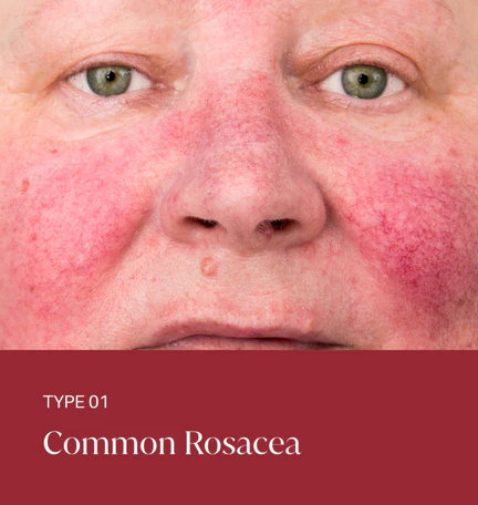 rosace-type-01 Type 1 - Common Rosacea