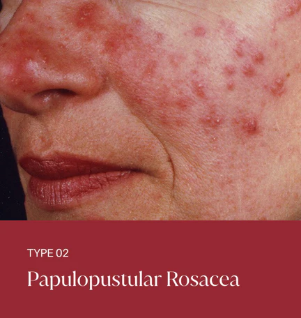 rosacea-type-02 Type 2- Papulopustular Rosacea