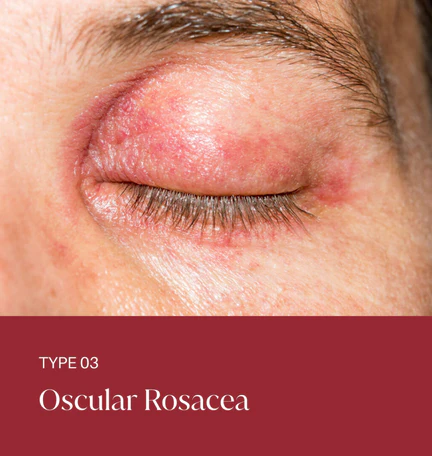 rosacea-type-03 Type 3- Oscular Rosacea