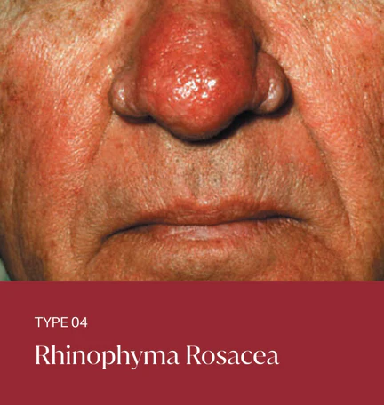 rosacea-type-04 Type 4: Rhinophyma Rosacea