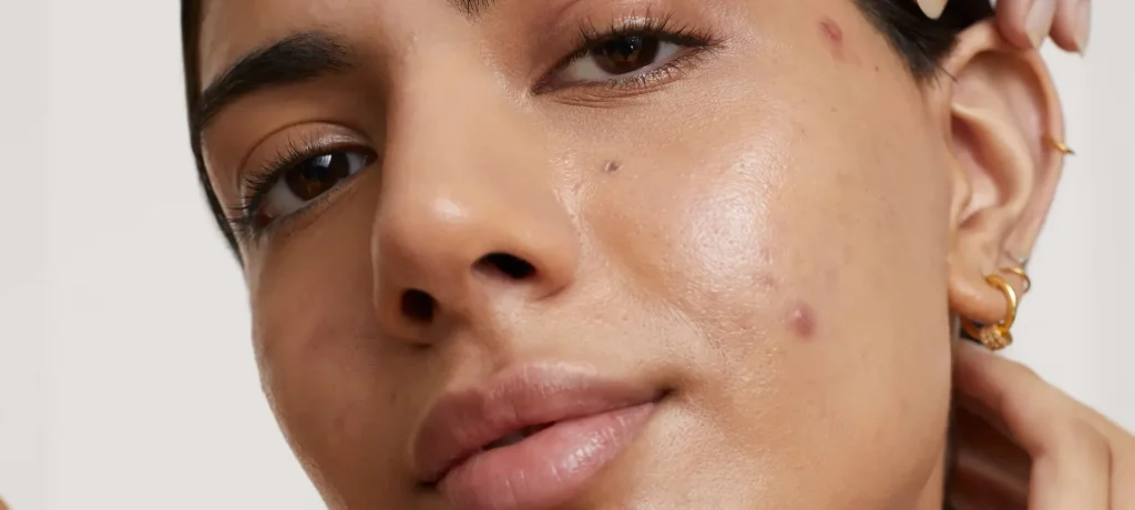 A lady with acne on her face | hero image used for guide to acne blog