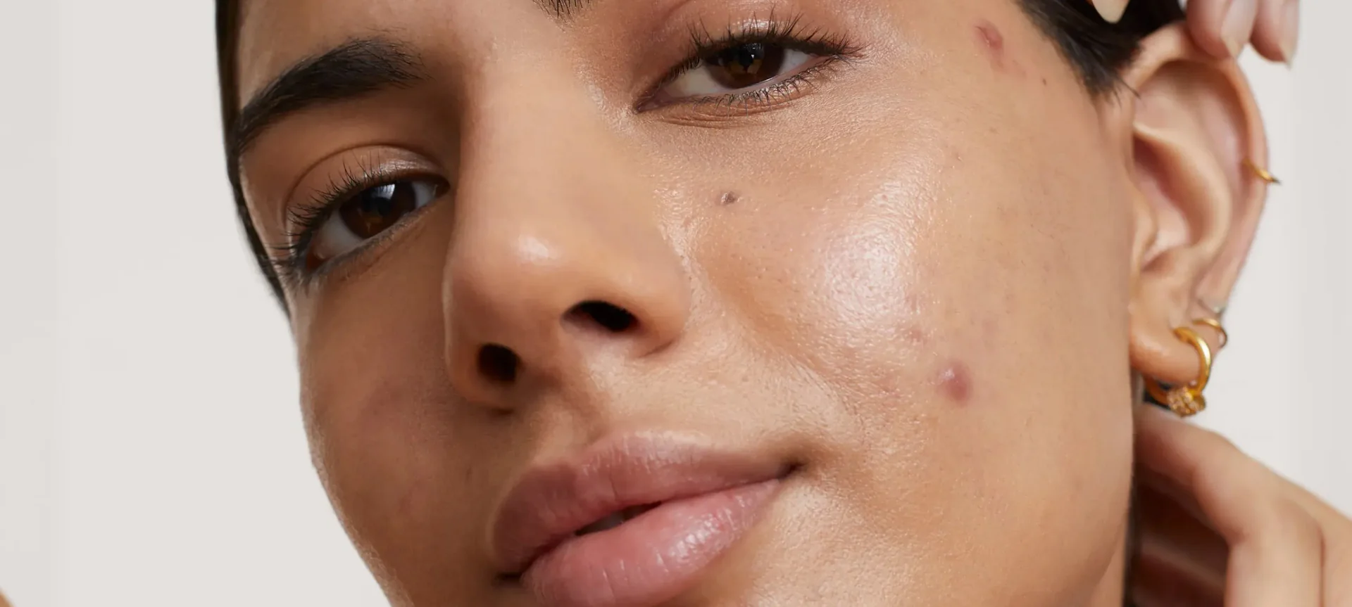 A lady with acne on her face | hero image used for guide to acne blog